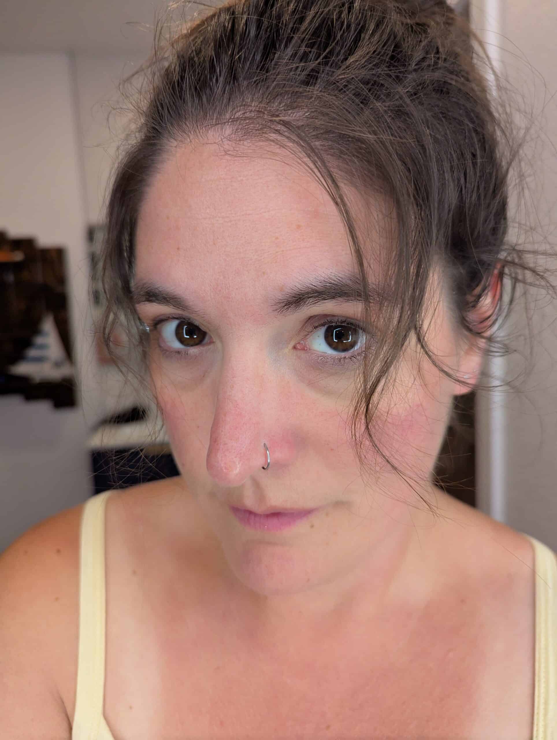 Hairline regrowth after about 5 months